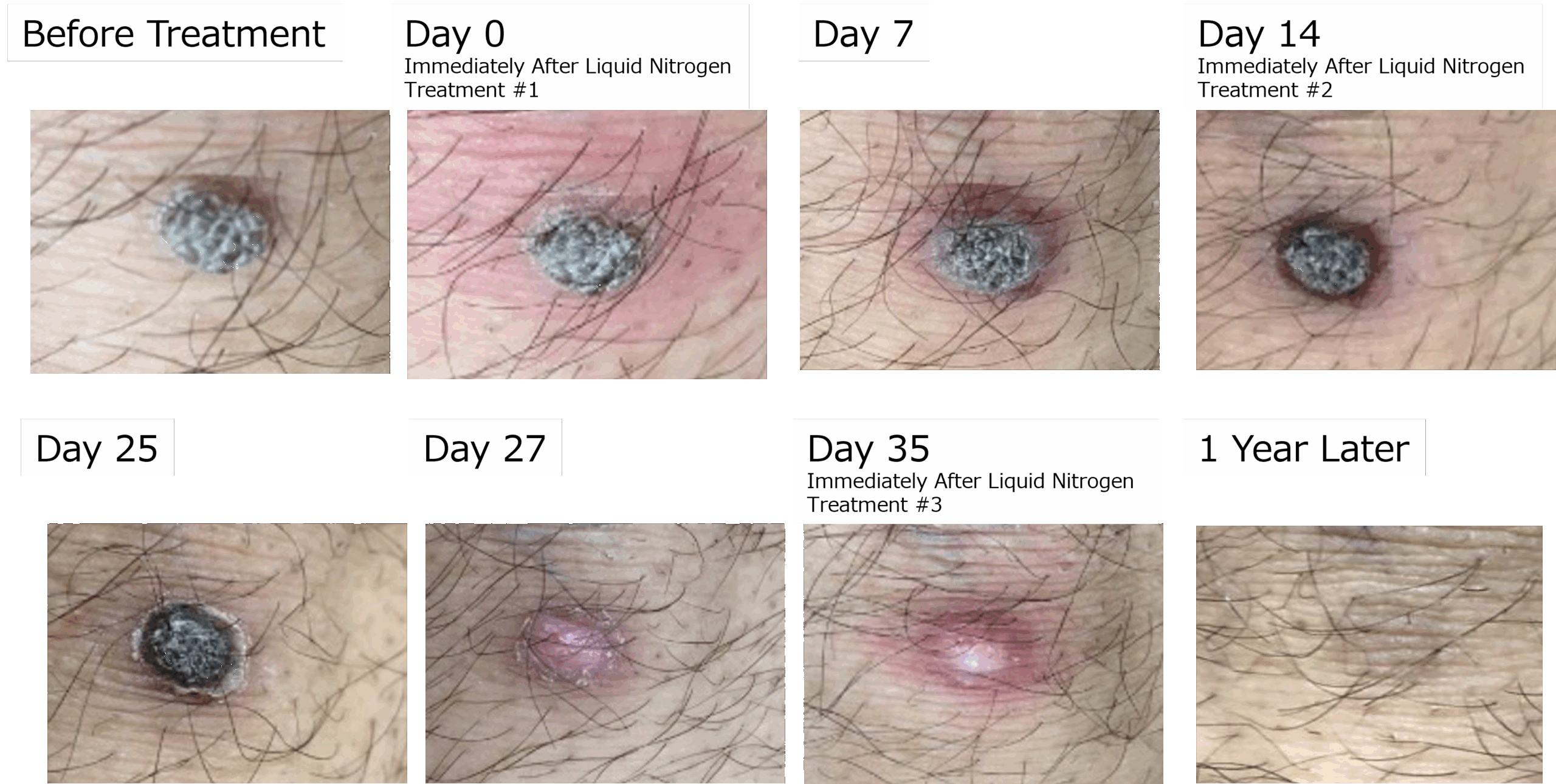 Wart treatment progress