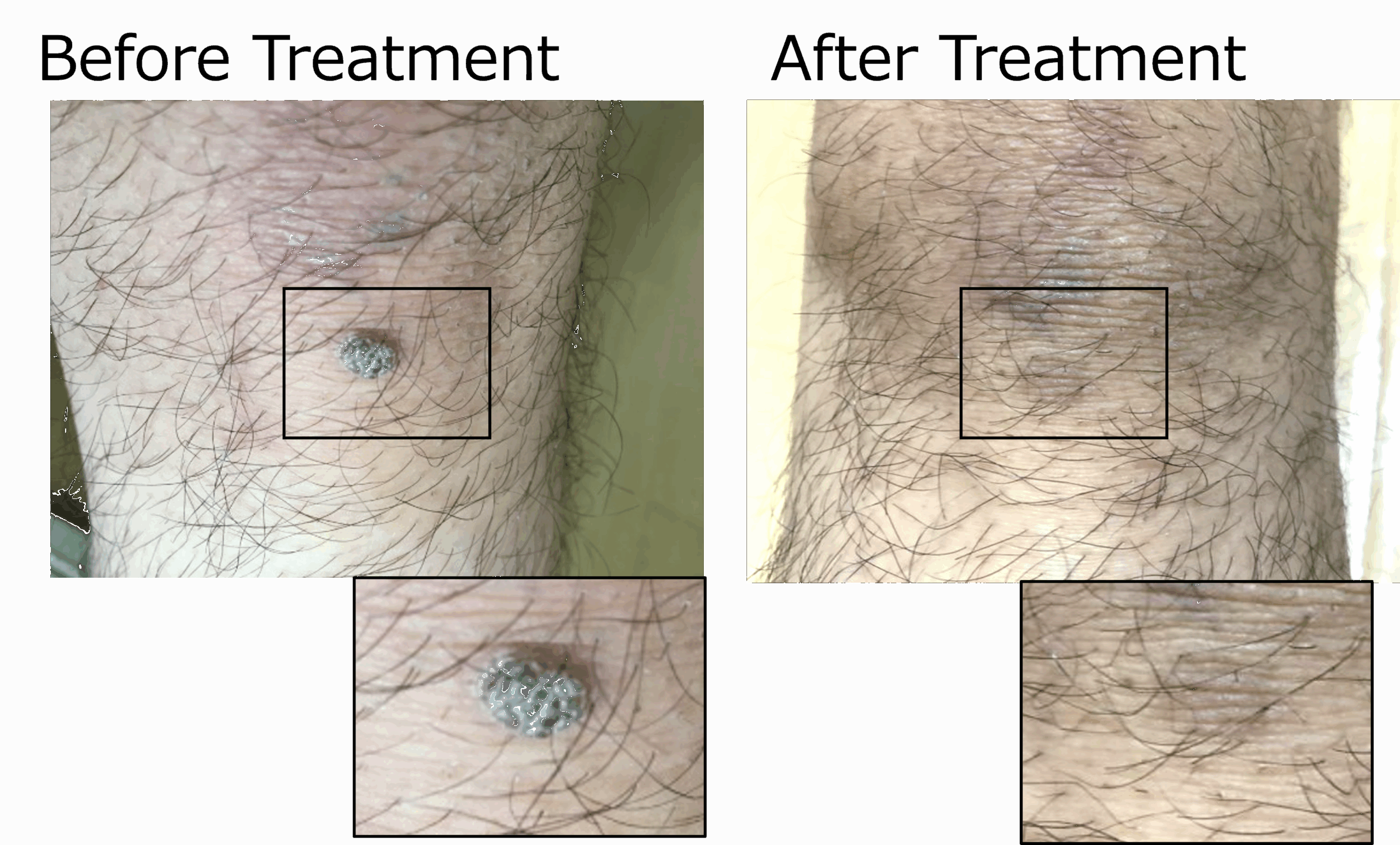Before and after wart treatment